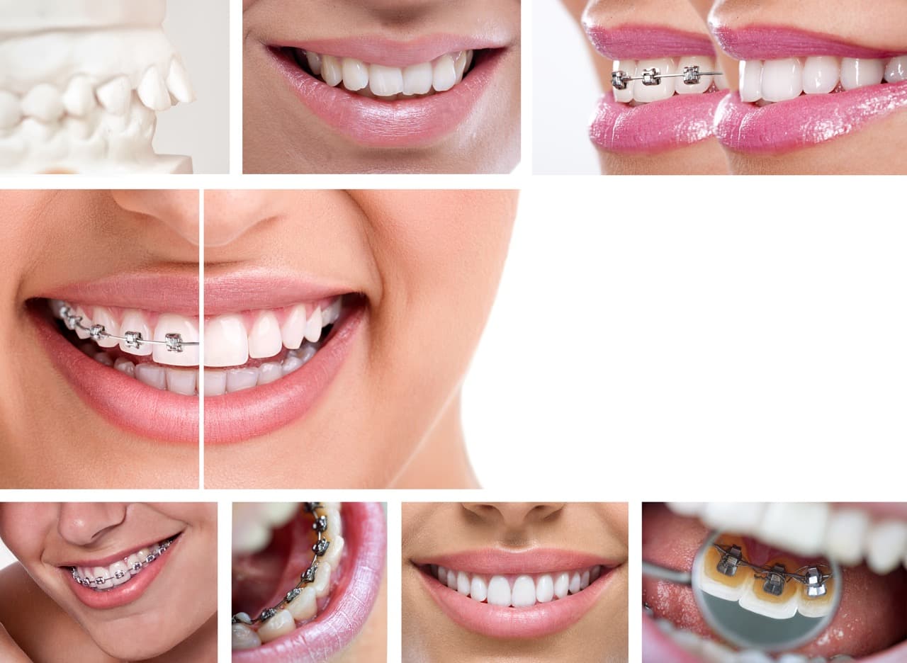 invisalign-vs-dental-braces-vs-lingual-braces